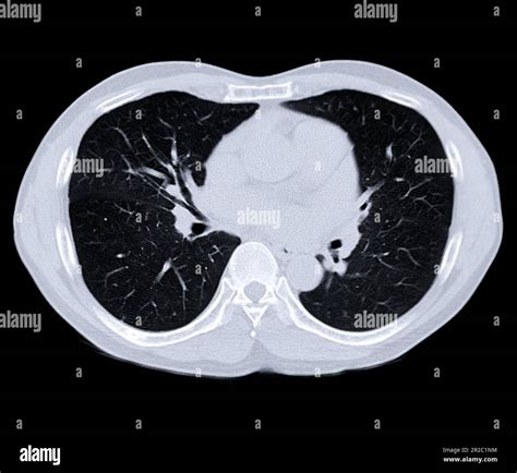CT Scan of Lungs .